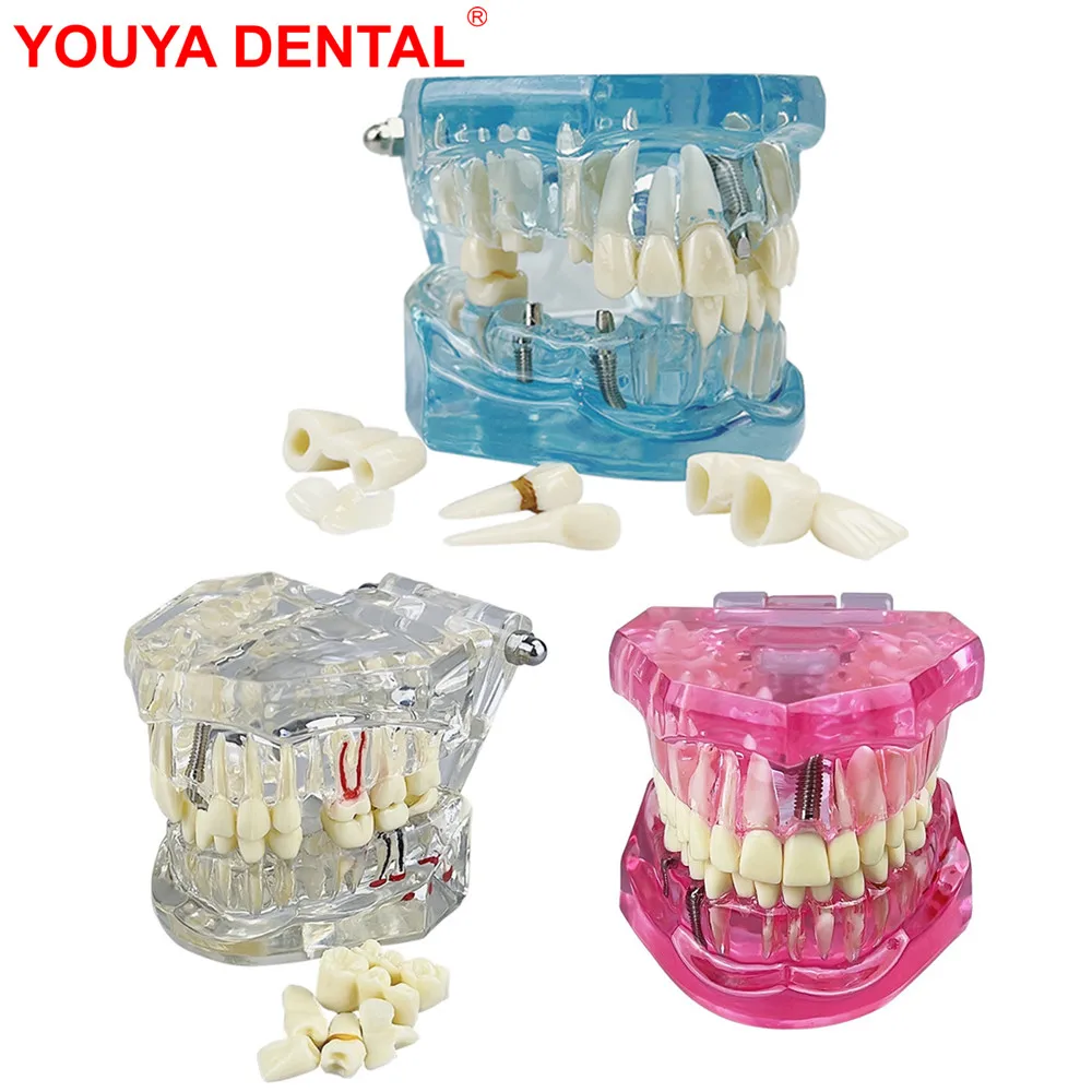 Standard Dental Teeth Model Implant Disease Dentist Studying Demo Dental Typodont Model With Removable Teeth Restoration Bridge