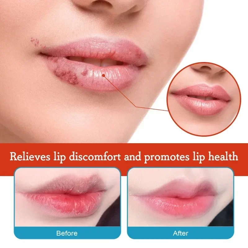 Cold Sores Lip Cheilitis Treatment Cream Herpes Antibacterials Ointment Chapped Lips Wrinkles Rehydration Plaster lip care