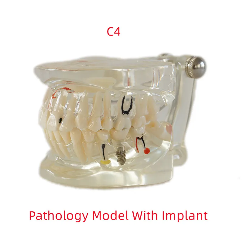 Model nauczania stomatologicznego Model patologii z pół/pełnym implantem C1/C4 dentysta narzędzia laboratoryjne