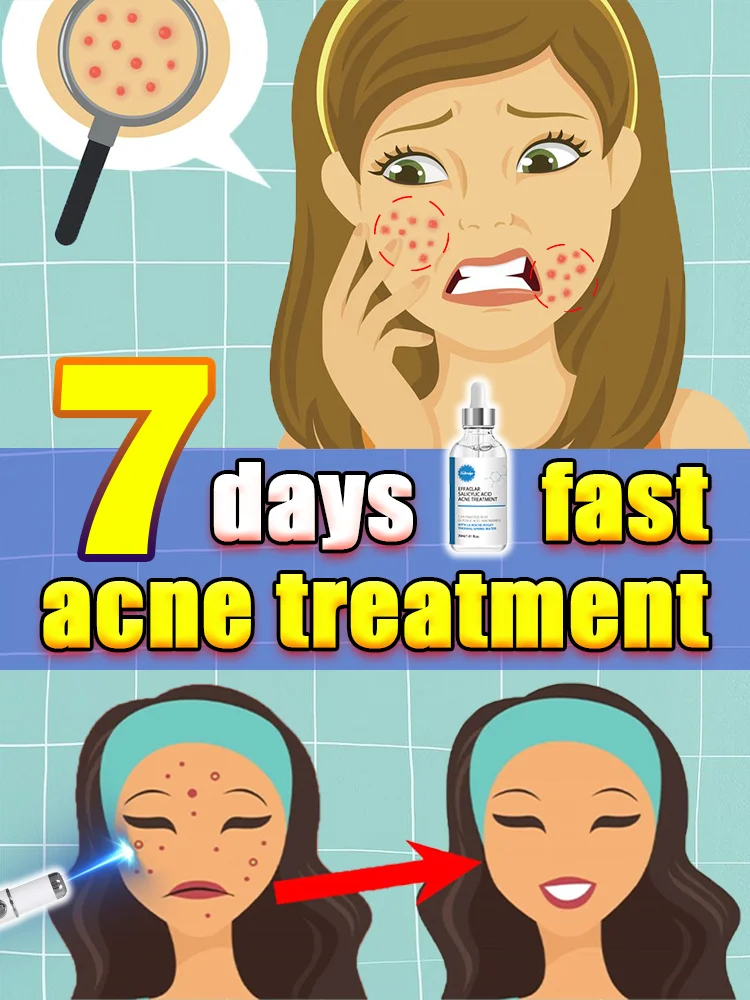 

Laser treatment for facial acne