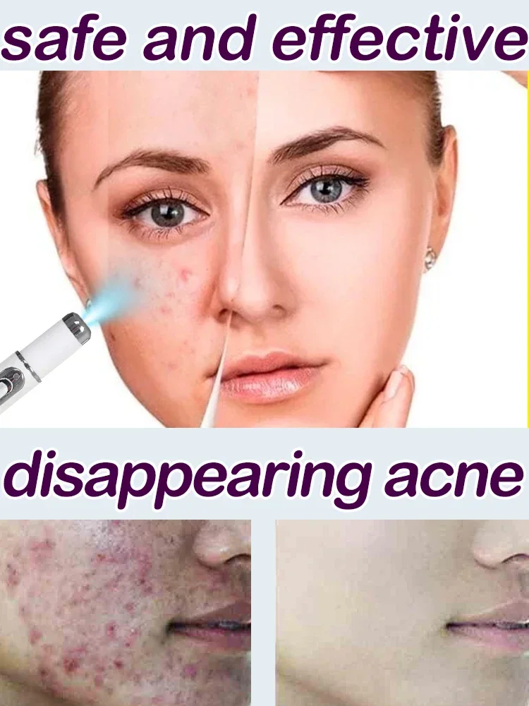 acne litteken laser gezichtsserum