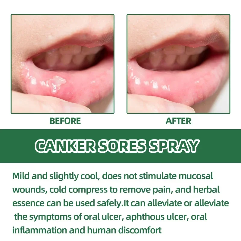 Mouth ulcer spray Treatment swollen gums oral Canker Sores Pain Relief fresh breath Antibacteria Halitosis mouth Clean care