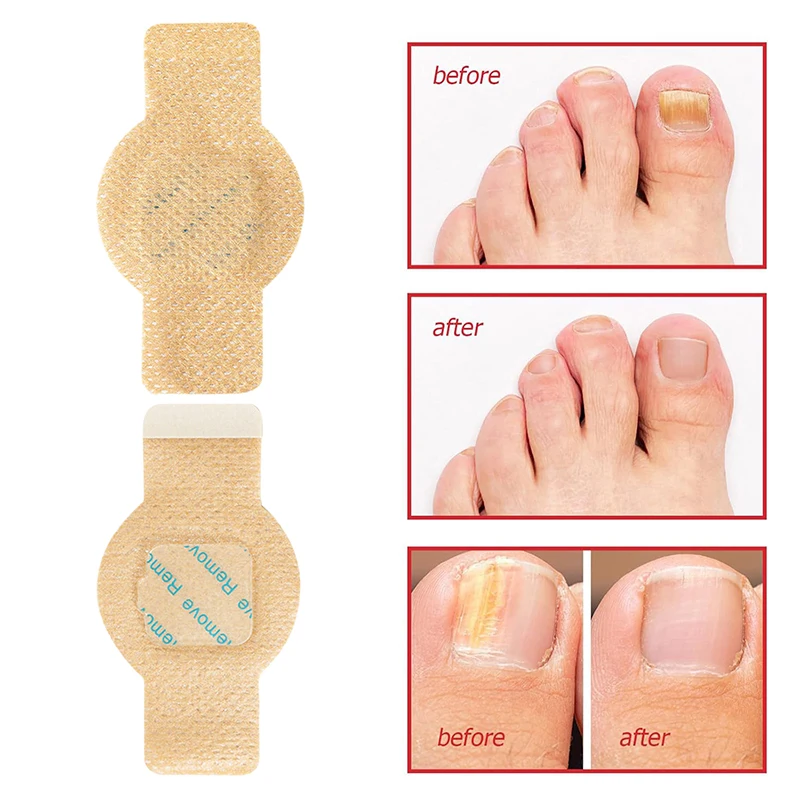 Parches para reparación de uñas, parche para hongos en las uñas de los pies, cuidado de las uñas de los pies pegajosas, pegatina de corrección encarnada, parche para tratamiento de paroniquia, 10/21 Uds.
