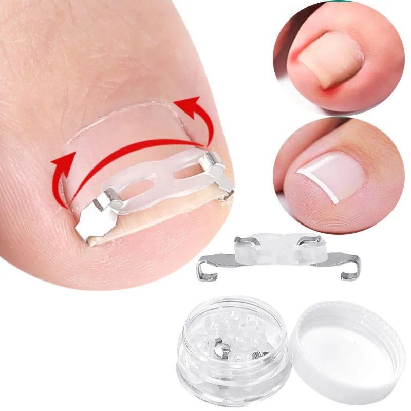 1/2 conjunto de ferramentas corretoras de unhas encravadas, pedicure, recuperação, tratamento de unhas, kit de reabastecimento de unhas, ferramenta de correção de cuidados com os pés