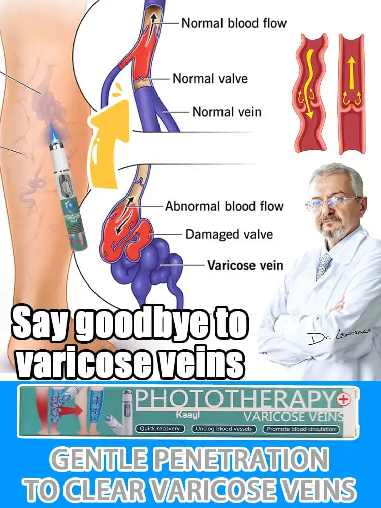 

Varicose vein laser pointer | for Anyone with Sedentary or Standing | Blue Light Laser