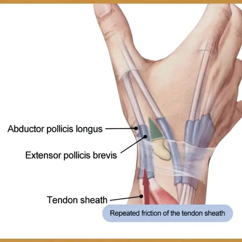 1 Stück flexible Handgelenkstütze mit Daumenstütze zur Linderung von Fingerschmerzen bei Arthritis für Arthritis-Patienten – Detail 6