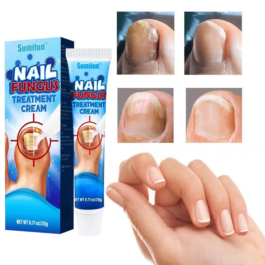 

20g Effective Nail Treatments Cream Nail Fungus Removal Cream Toenail Onychomycosis Repair Soft Paronychia Nail Ointment