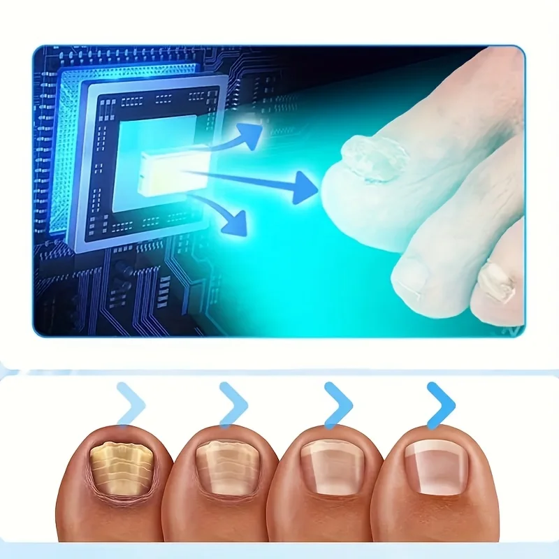 

1/2/4 Pcs Nail Fungus Light Device for Toenails and Fingernails
