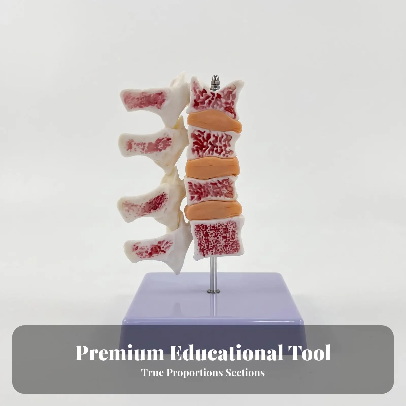 PVC Spine Lesion Specimen Anatomical Model with Osteoporosis Details for Medical Education Classroom Display