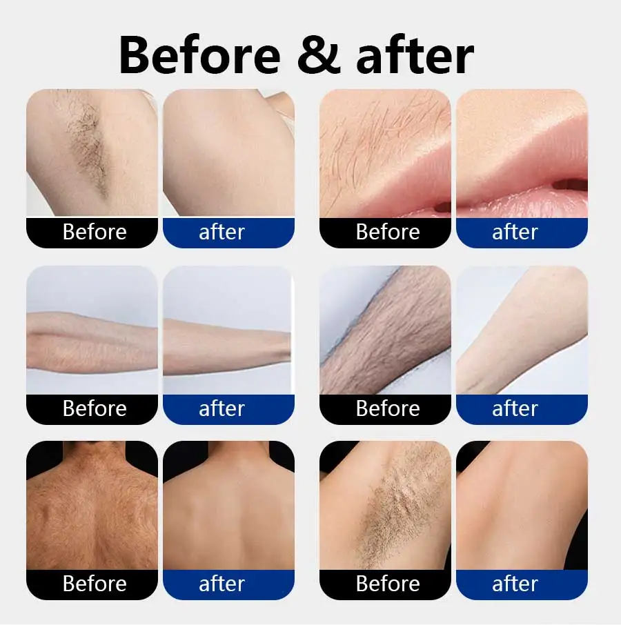 5 Wavelength Diode Laser Hair Removal Machine FAC Technology Genuine Sapphire Ice Cooling Painless Permanent Hair Remover Salon
