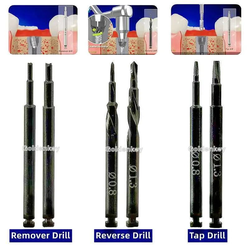 Dental 0.8mm/1.3mm Implant Fixture Fractured Broken Screws Removal SOS Remove Tap Extractor