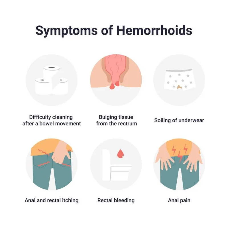 Fast Treatment Hemorrhoid Hemorrhoid Hemorrhoid Balls Effective Prevention Toxaemia Caused Hemorrhoids External Anal Fissure