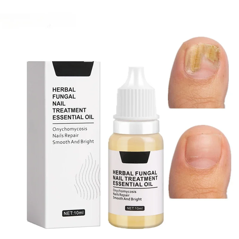 Grey Nail Repair Liquid Concave Thick Nail Removal Soft Nail Brightening Repair Liquid