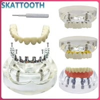 Modelo de implante Dental, simulación de restauración de mandíbula superior/inferior, sobredentadura, extraíble, 4/6 tornillos de implantes, modelo de demostración de enseñanza Dental