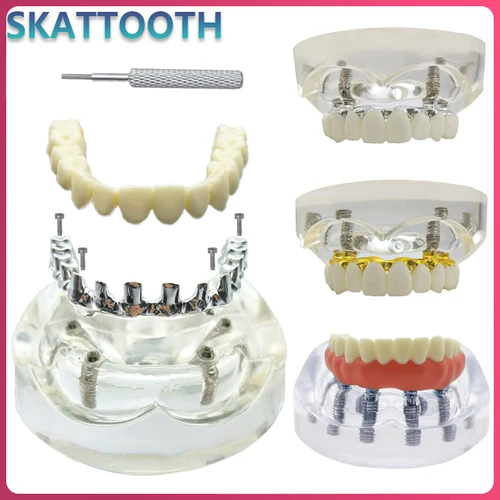 Modelo de implante Dental, simulación de restauración de mandíbula superior/inferior, sobredentadura, extraíble, 4/6 tornillos de implantes, modelo de demostración de enseñanza Dental