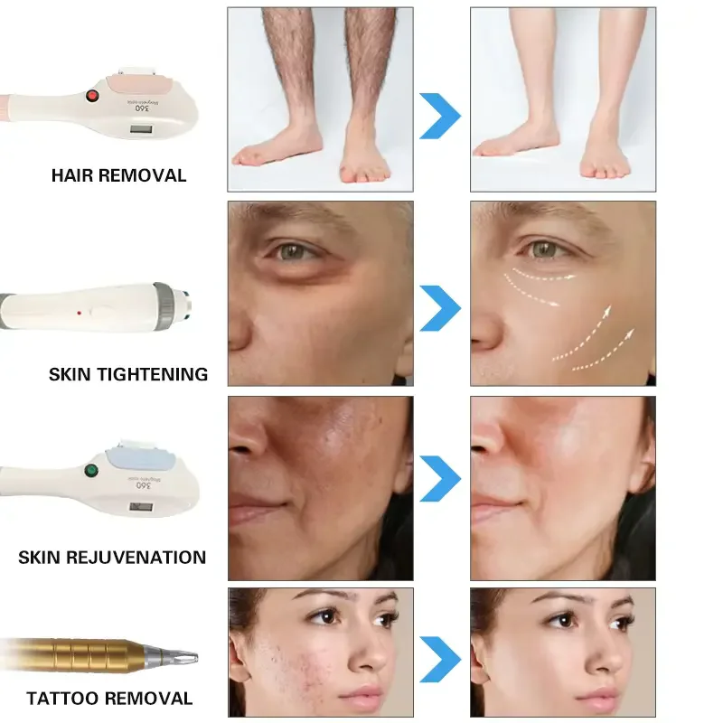 4 in 1 ringiovanimento della pelle detergente profondo hiar rimuove la macchina di bellezza ipl laser a diodi per la rimozione del tatuaggio laser a picosecondi