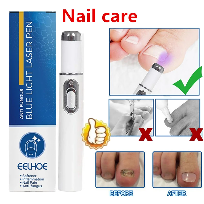 Máquina de cura a laser para fungos nas unhas, dispositivo per cuidados com os pés, tratamenti de unhas, anti-infezione, paroní