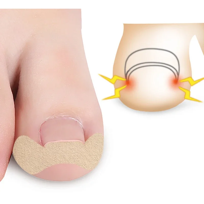 1/3/5SET Patches Treatment Sticker Inlay Nail Corrector Stickers Ingrown Toenail Toenail Correction Stickers Toenail Corrector