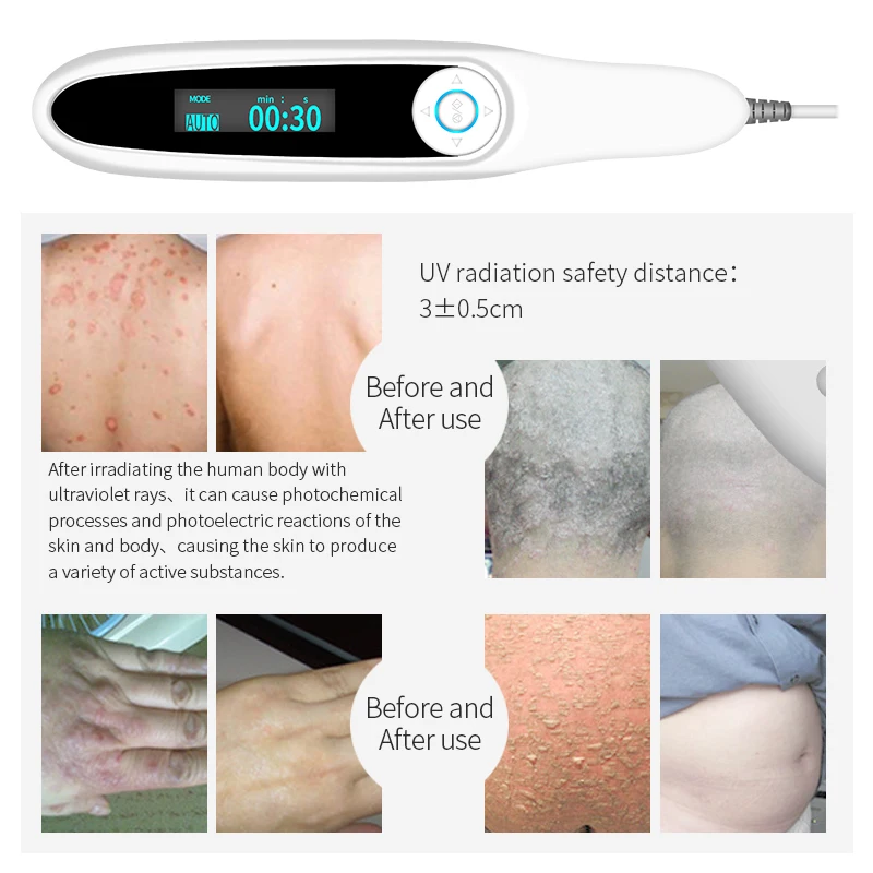 Dispositif de traitement du Vitiligo 311nm, Instrument de photothérapie ultraviolette à bande étroite, lampe UVB, photothérapie pour la thérapie du Psoriasis
