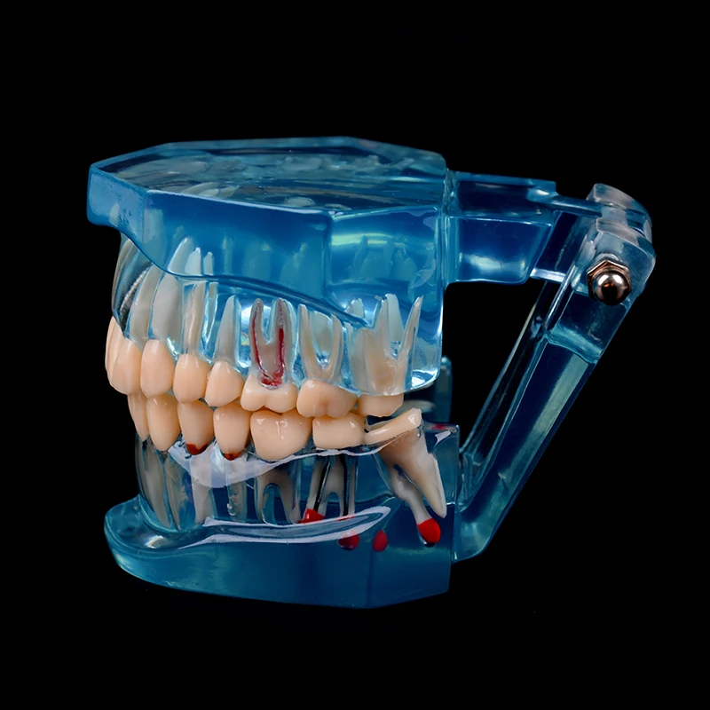 Modelo de dientes con implante Dental para enseñanza médica, cuidado de la salud Oral, ciencia, enseñanza de enfermedades dentales, gran oferta