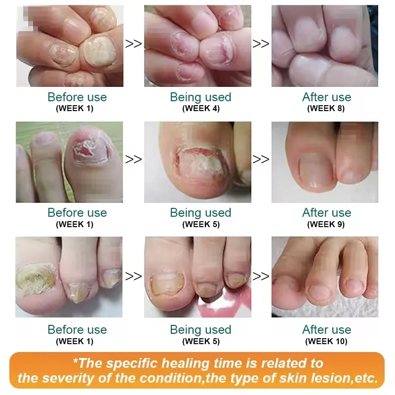 7 giorni Trattamento Fungo Delle Unghie Siero Riparazione Unghie Dei Piedi Rimozione Fungine Essenza Anti Infezione Paronichia Onicomicosi Assistenza Sanitaria