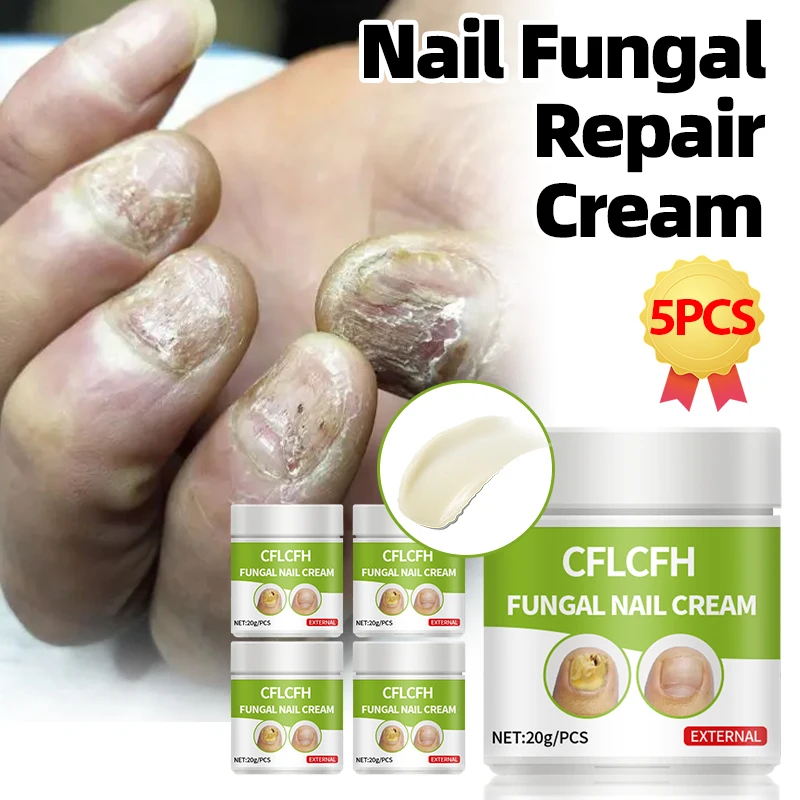 Nail Fungus Treatment Cream Offers Toe Onychomycosis Therapy, Paronychia Relief, and Ingrown Toenail Removal Plaster