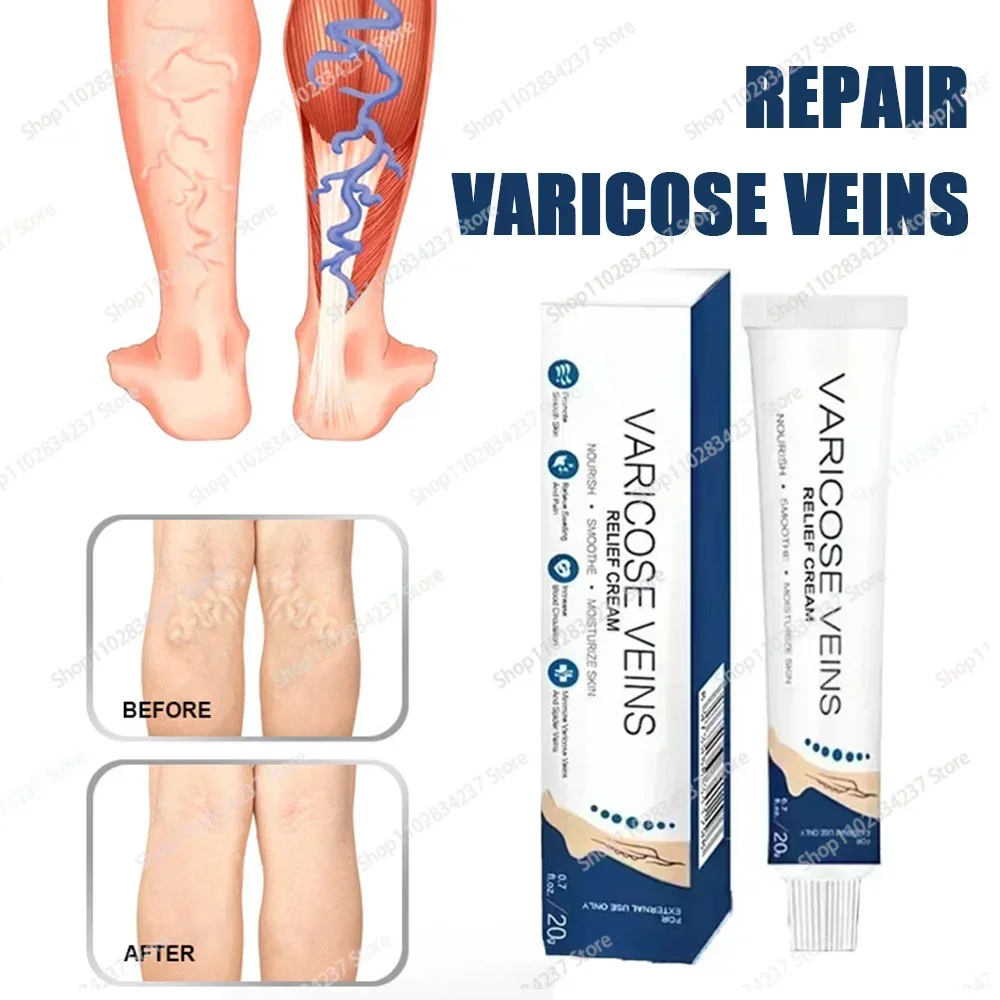 

Leg Varicose Vein Repair Cream Quickly Relieves Leg Tiredness and Heaviness 0923