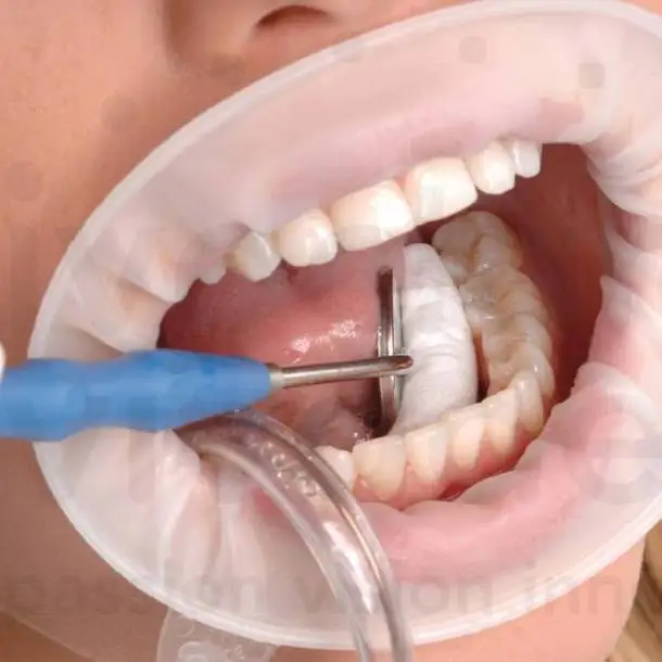 3D Dental otwieracz do ust wargi policzek zwijacz kształt O regularny mały rozmiar młodzieżowy