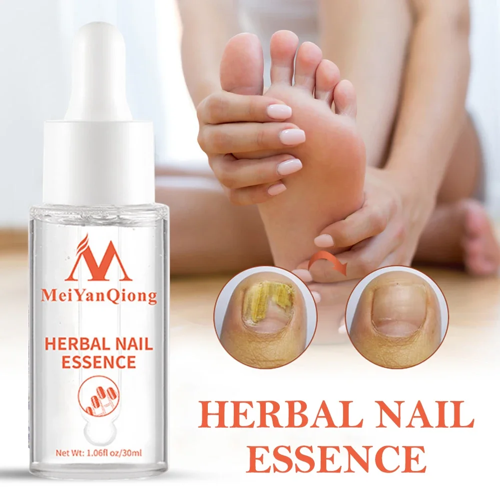 Toenail Repair Essence Anti Infection Nail Fungus Treatments Essence Feet Onychomycosis Repair Essence Supply Unisex 발톱무좀