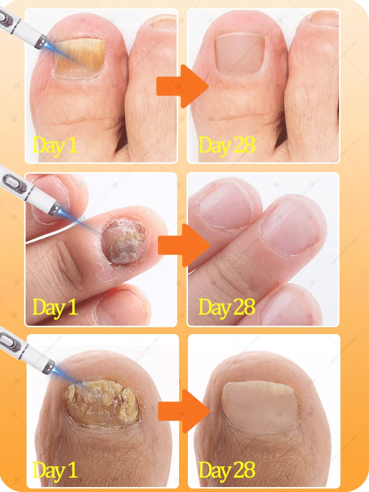 บอกลาเล็บเชื้อรา การเปลี่ยนเล็บที่ไม่เจ็บปวด