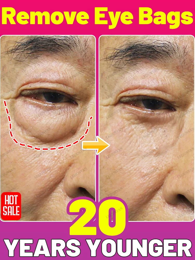 

｜Eᴀʀʟʏ ᴍᴏʀɴɪɴɢ ᴇᴍᴇʀɢᴇɴᴄʏ ғᴏʀ ᴇʏᴇ ʙᴀɢs｜Rᴇᴍᴏᴠᴇ ᴘᴜғғɪɴᴇss｜Bʀɪɢʜᴛᴇɴ ᴛʜᴇ ᴇʏᴇ