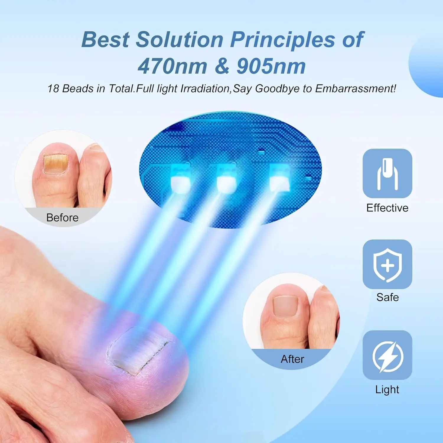 Nail Fungus Laser Device for Multiple Toenail 905nm470nm 7Minutes Painless Removes Ingrown Toenail Calcium Nail Fungus Treatment