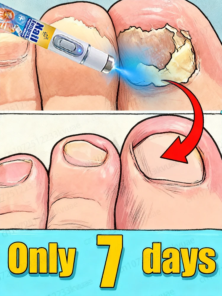 

Lazi분 пытают , безопасное и быстрое устранение онихомикоза