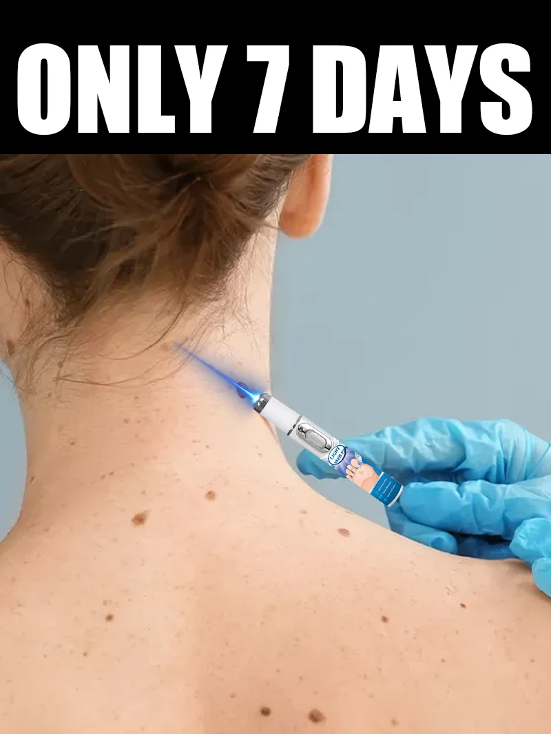 Wart blue light tool, more discounts on sets