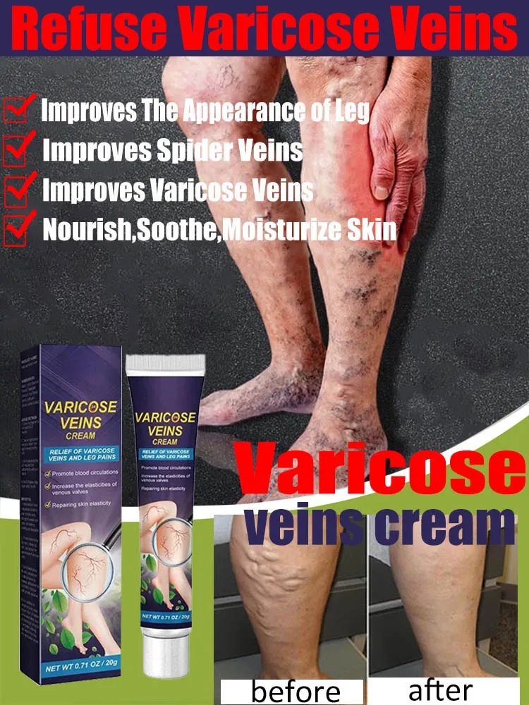 Effective Varicose Vein Relief Cream Ointment Leg Vasculitis Phlebitis Spider Shape Vein Pain Relief Ointment Angiitis Removal