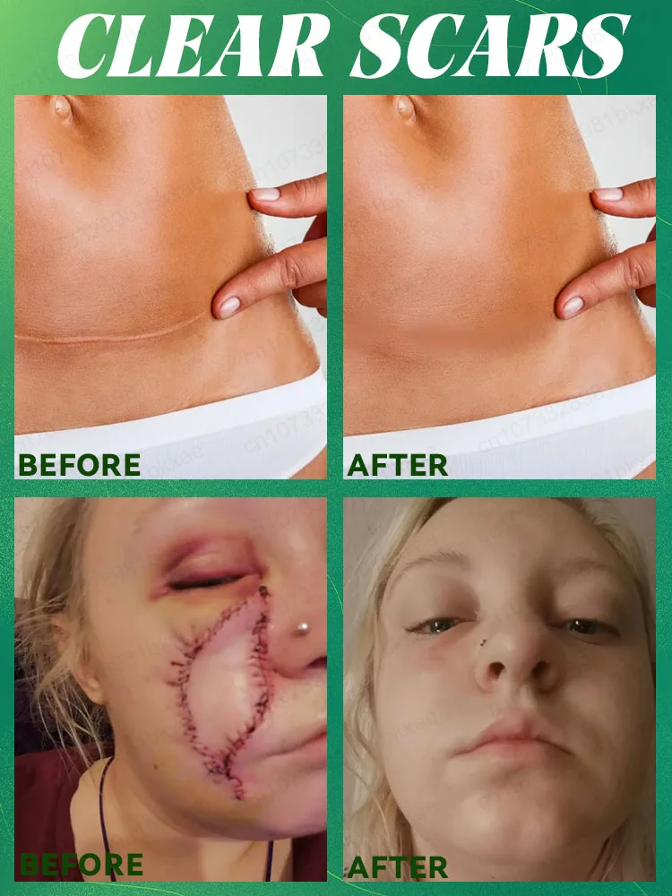 Scar removal, skin restoration