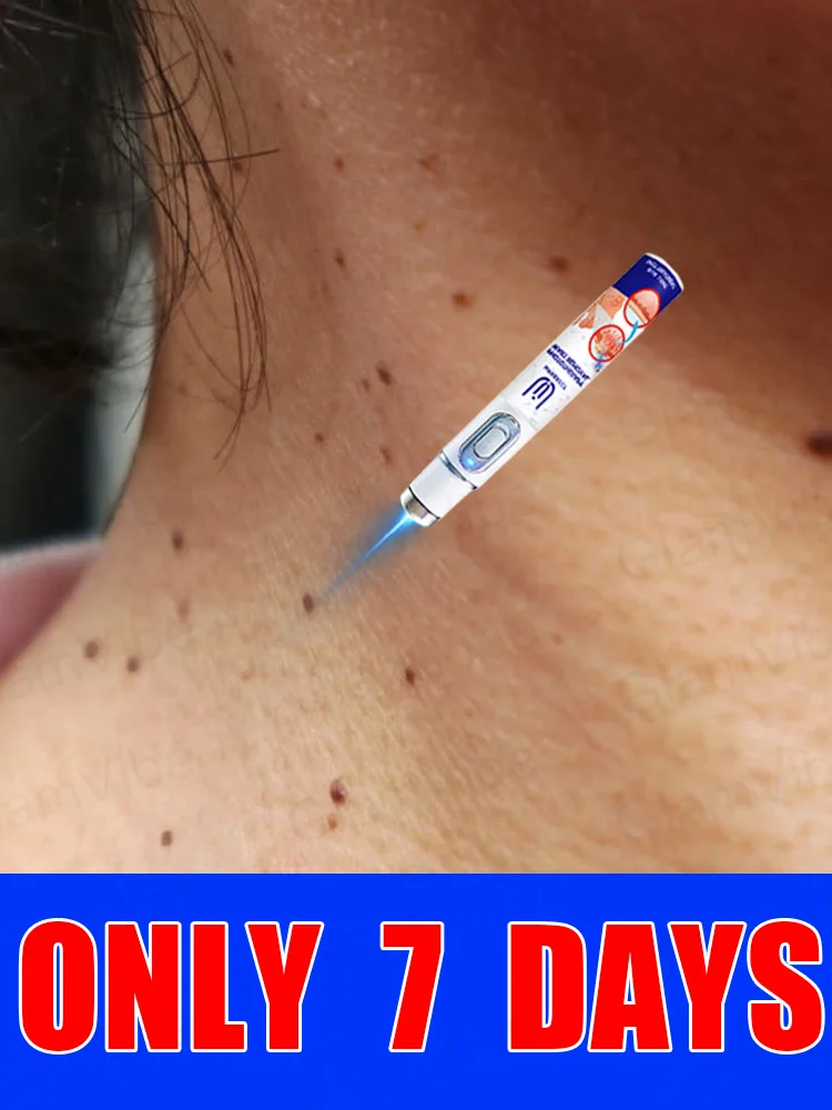 

blue light pen solve warts, hot sale wart care tools