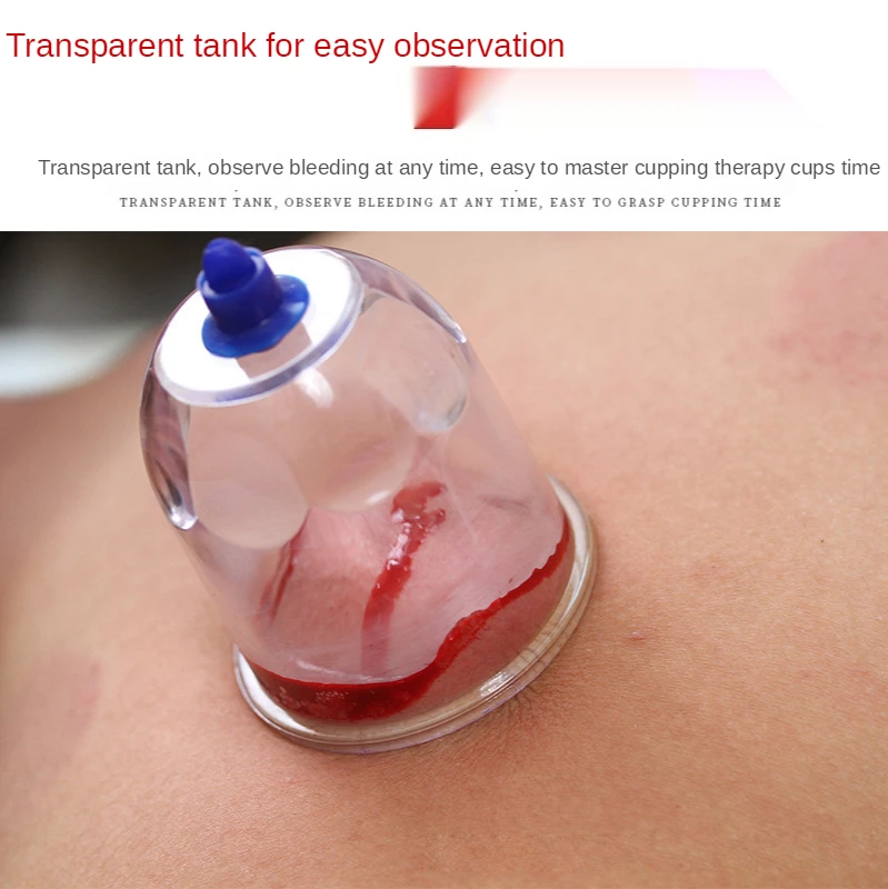 Bloodletting bloodletting vacuum cupping device household aspirating type gas tank blood stasis removal cupping blood