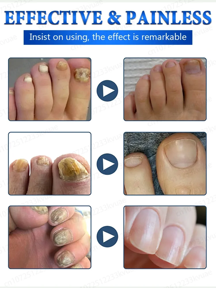 ¿Aún sufres de dolor en las uñas? Solo se necesitan 7 días para eliminar rápidamente las bacterias y recuperar la confianza.