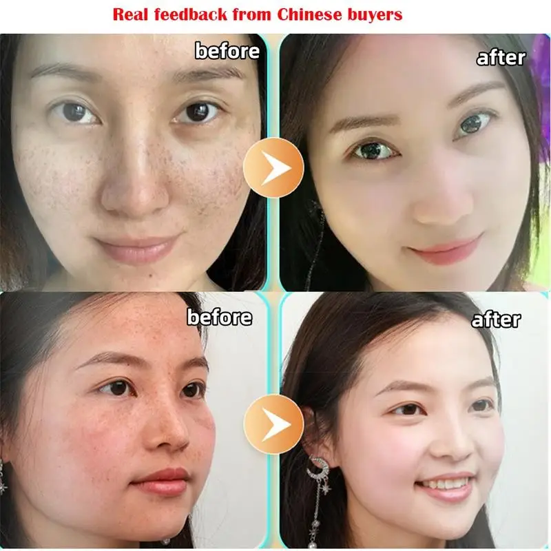 Dark Spot Corrector Skin Whitening Fade Cream Lighten Blemish Removal Serum Reduces Freckles Melasma Sun Spot Brighten Skin Care