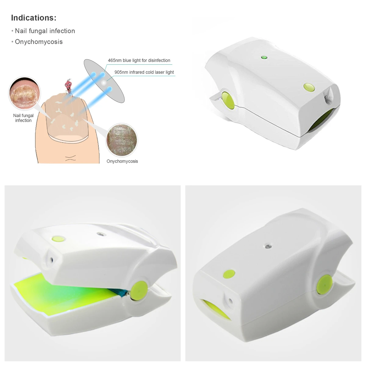 

Home Use Laser Device for Nail Fungus Removal Effective Toenail Fingernail Treatment