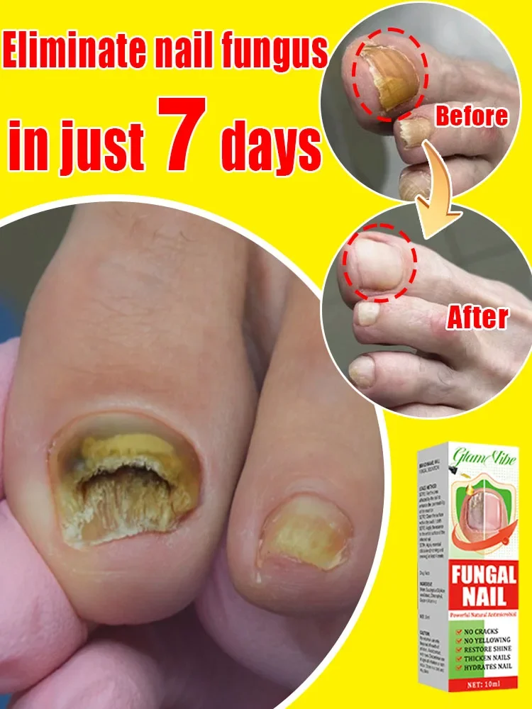 Eliminate nail fungus and say goodbye to onychomycosis.