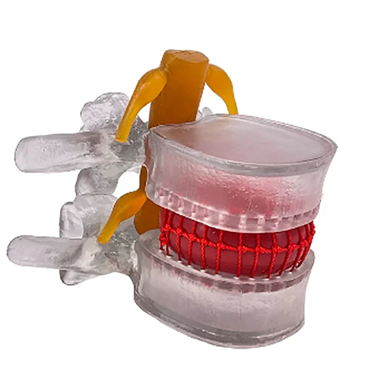 Enlarged Lumbar Spine Disc Pressure Demonstration Model Human Spine Pathological Intervertebral Disc Model