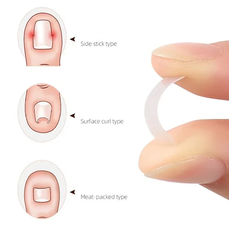 10 pezzi trattamento delle unghie dei piedi incarnite strumento di correzione dell'unghia del piede incarnita adesivo patch elastico raddrizzamento clip tutore strumenti per pedicure
