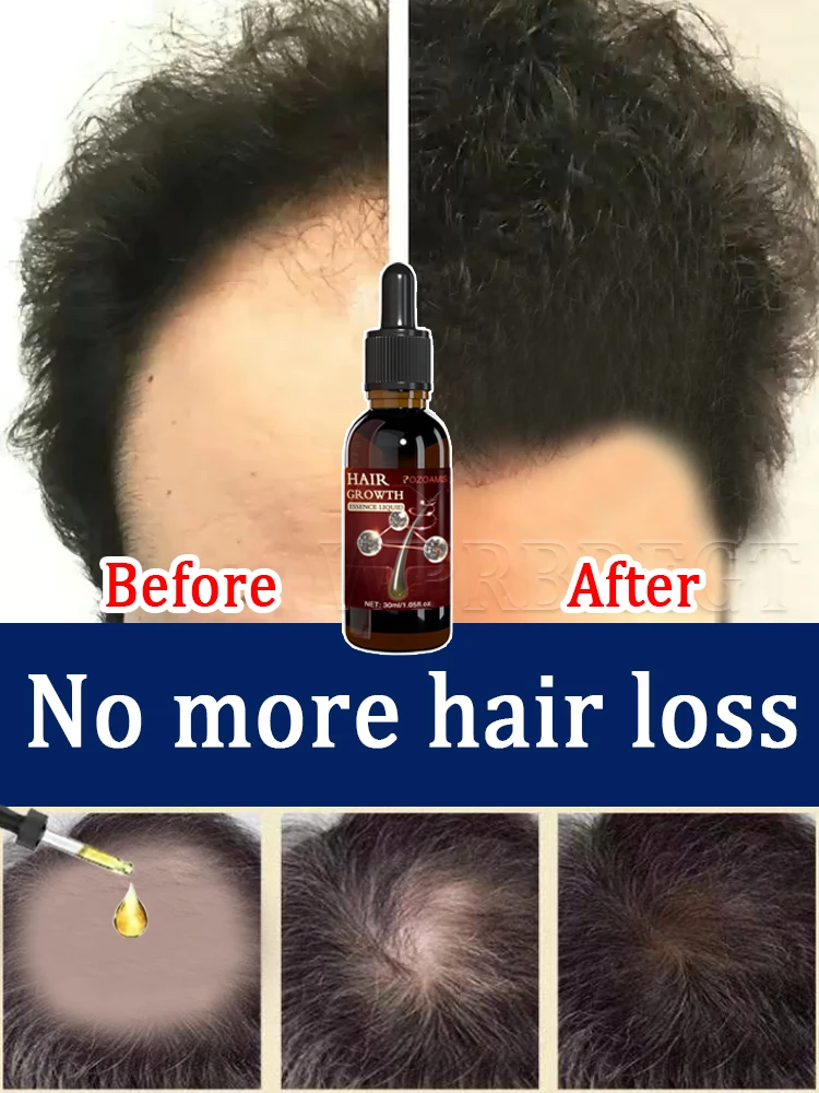 99% des acheteurs dites c'est bon, il peut restaurer les cheveux épais et la croissance des cheveux n'est plus un rêve