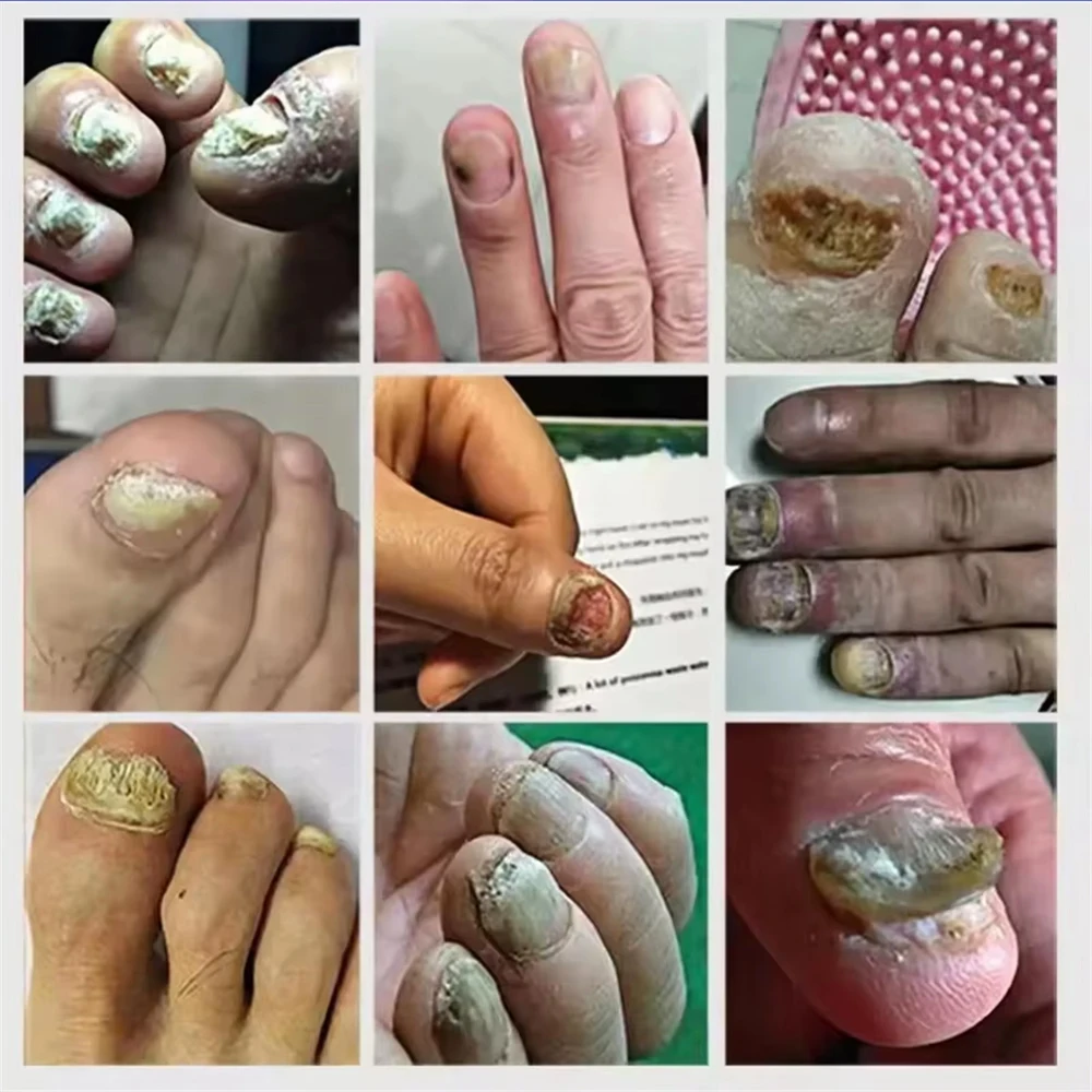 Sérum de réparation fongique des ongles, élimination des champignons des ongles des orteils, huile essentielle, Anti-Infection, Onychomycose, Paronychia, soins réparateurs