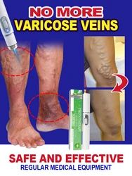 Powerful Laser Therapy for Moderate Varicose Veins, Relieve Pain and Improve Circulation for Both Men and Women