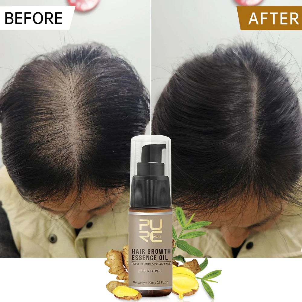 

PURC Hair Growth Oil Ginger Hair Growth Products for Men Women Anti Hair Loss Scalp Treatments Fast Regrowth Thickening Oils