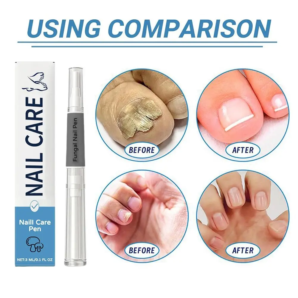 Professionelle Pflege Nagelhautöl Nagelpilz Stift Behandlung Serum Erweiterte Formel Nagelserum Pilz Nagelstift Fußpflege