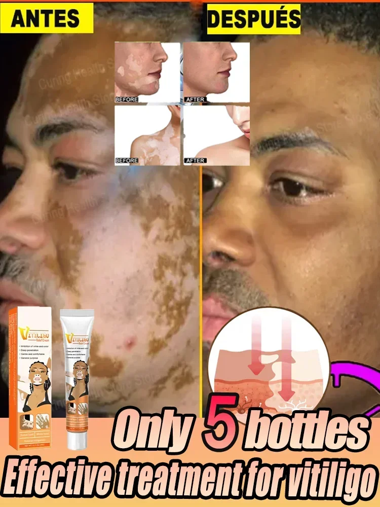 Vitiligo Ointment Effectively Improvement Skin Eliminate White Spot s18